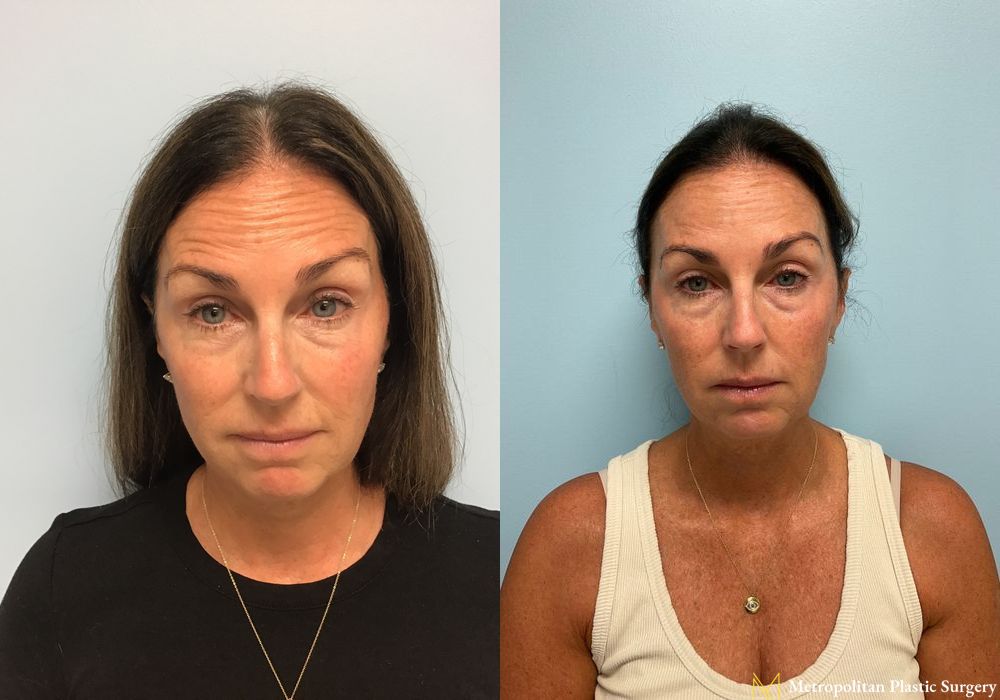 BOTOX® Cosmetic - Case 143