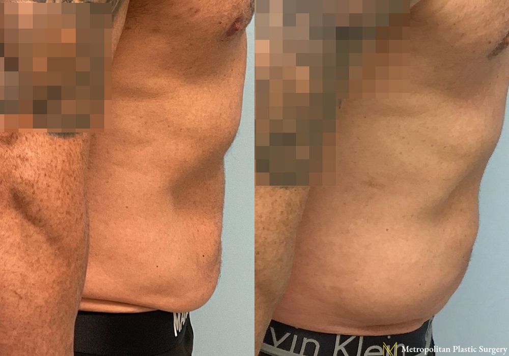 Liposuction - Thumbnail 2