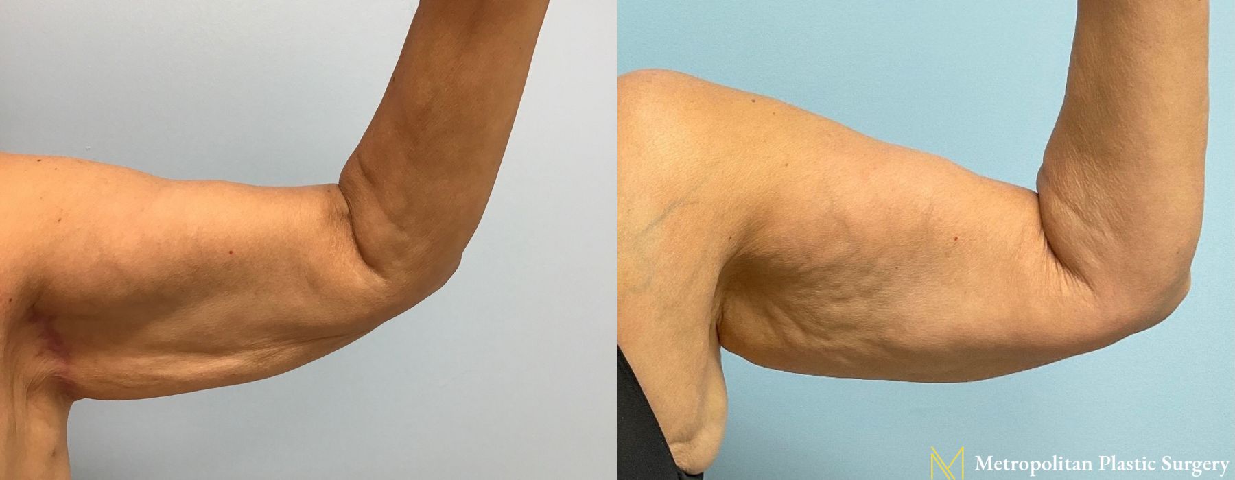 Brachioplasty - Thumbnail 3