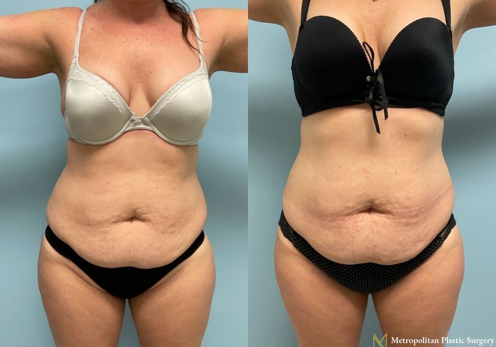 Liposuction - Case 204