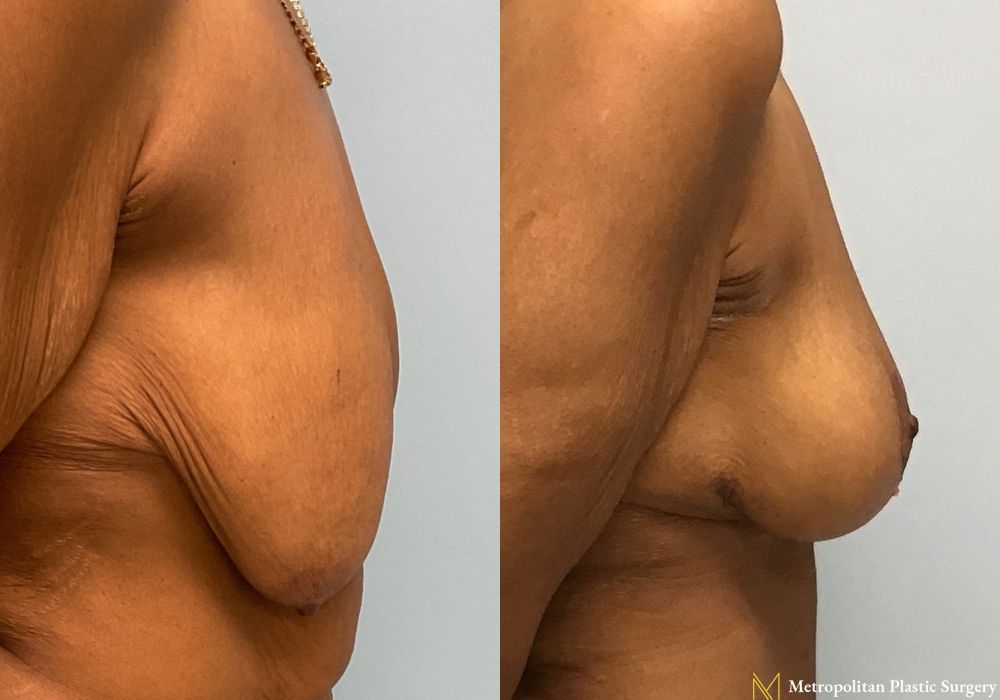 Breast Lift - Case 98