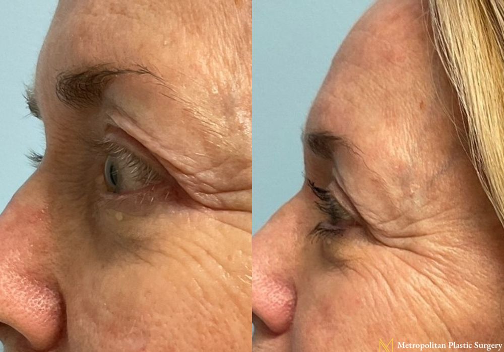 Blepharoplasty - Thumbnail 2