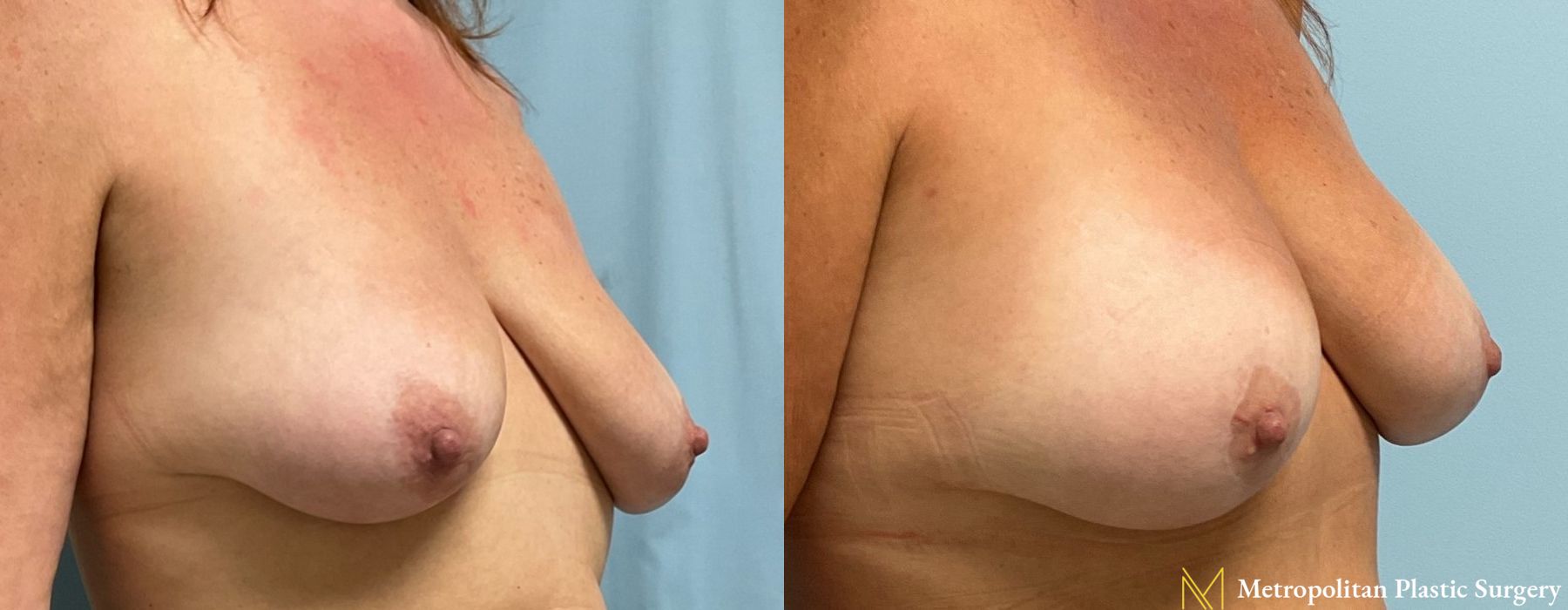 Breast Lift - Thumbnail 3
