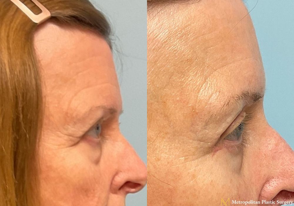 Blepharoplasty - Thumbnail 2