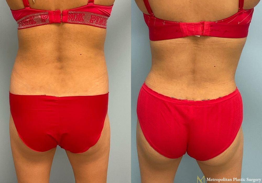 Liposuction - Thumbnail 6