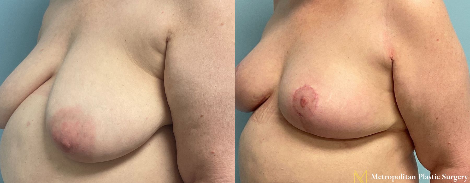 Breast Lift - Thumbnail 5