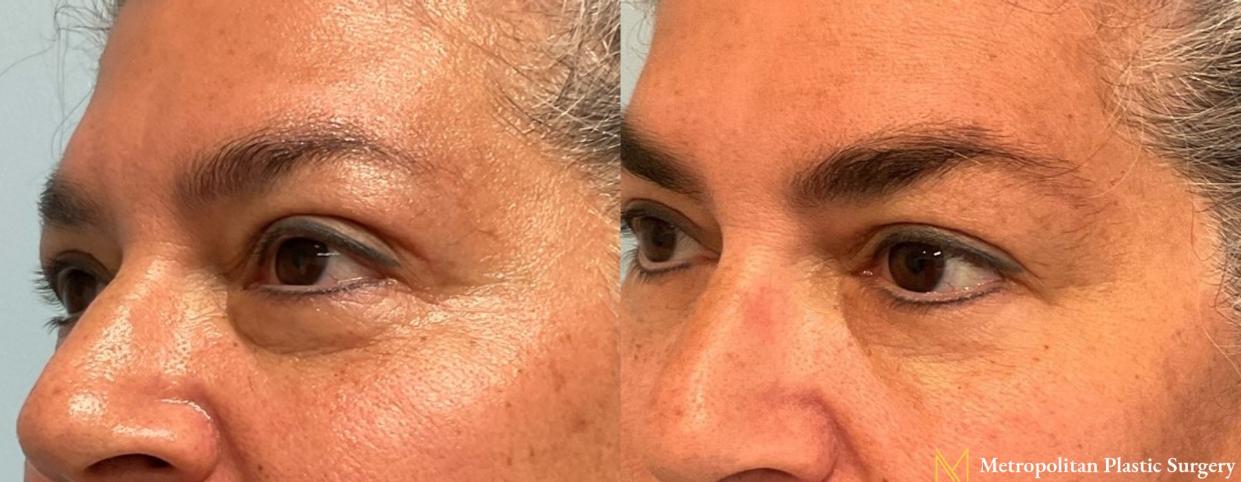 Blepharoplasty - Thumbnail 3