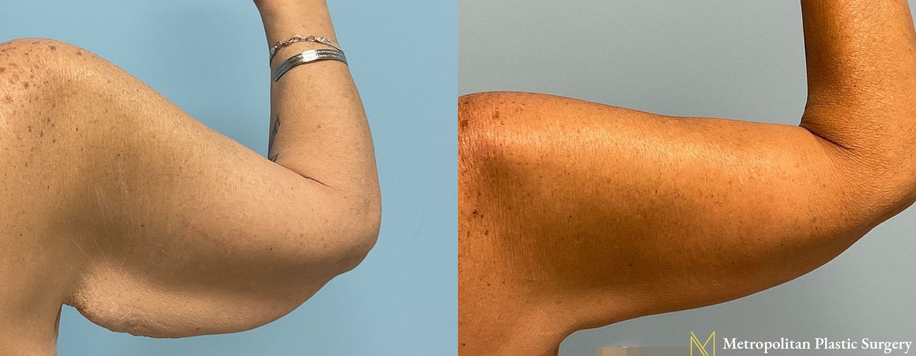 Brachioplasty - Thumbnail 2
