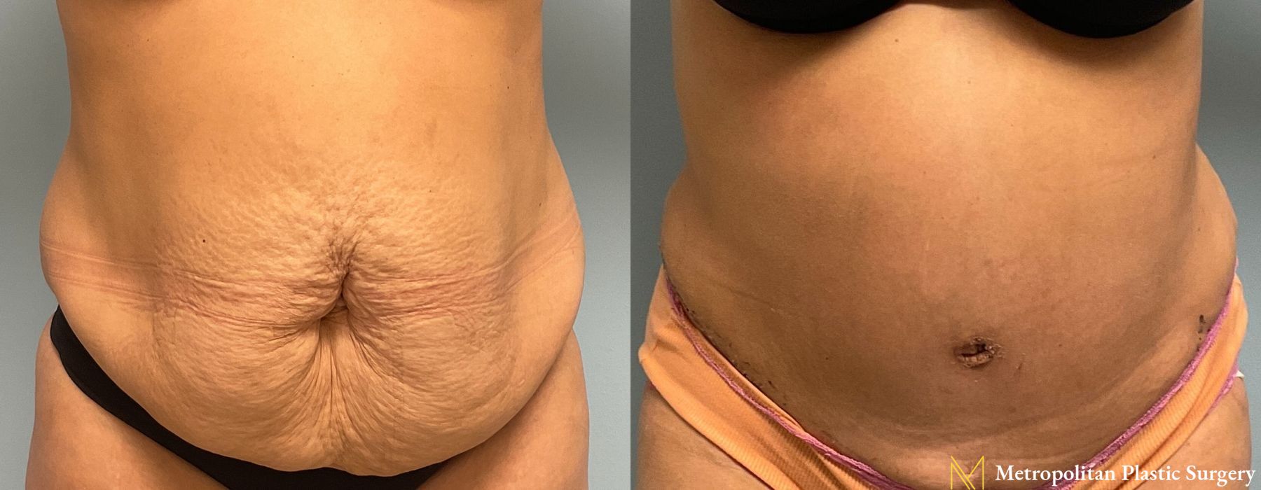 Liposuction - Case 214