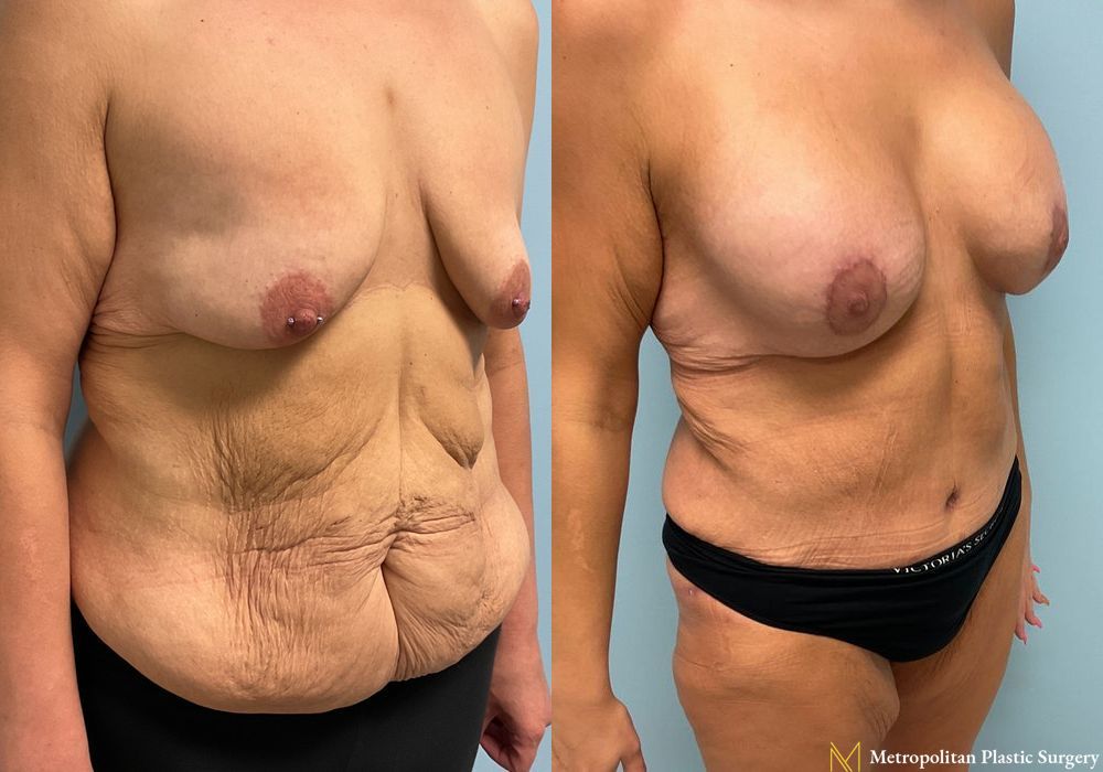 Abdominoplasty - Thumbnail 2