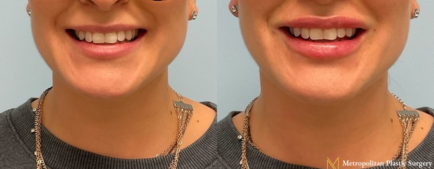 Fillers - Thumbnail 3