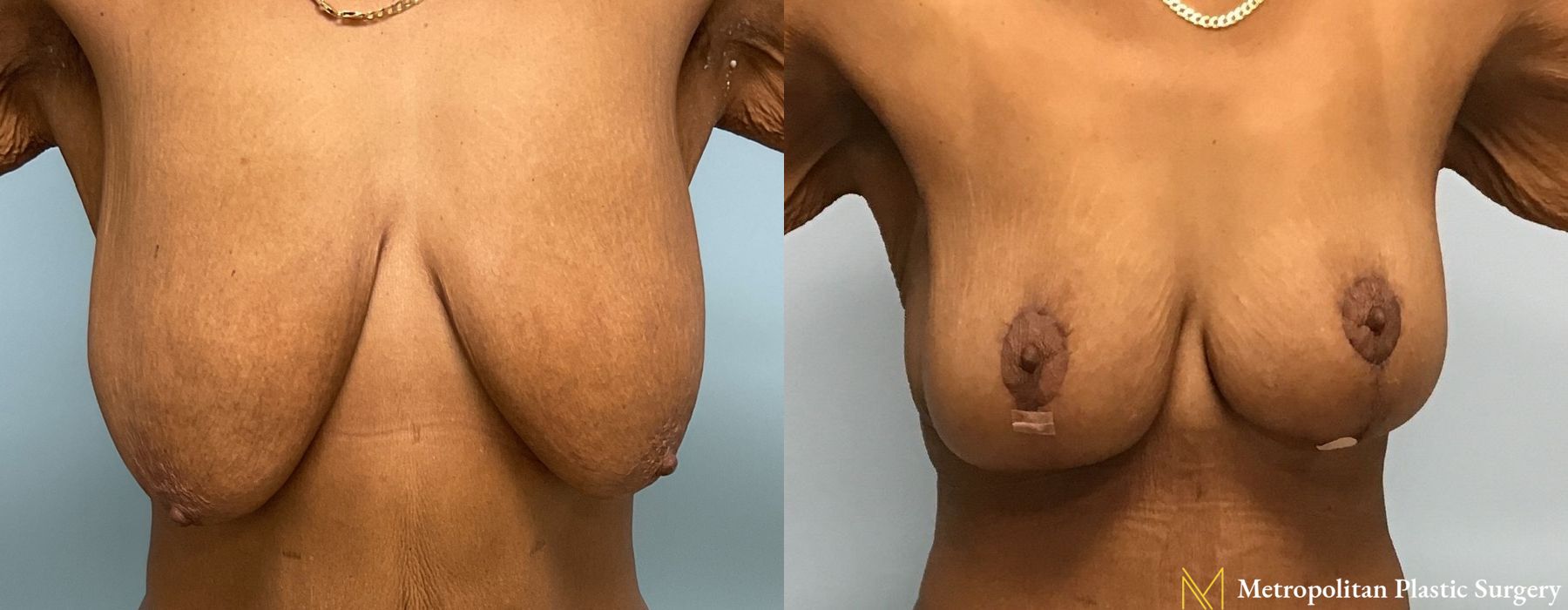 Breast Lift - Thumbnail 3
