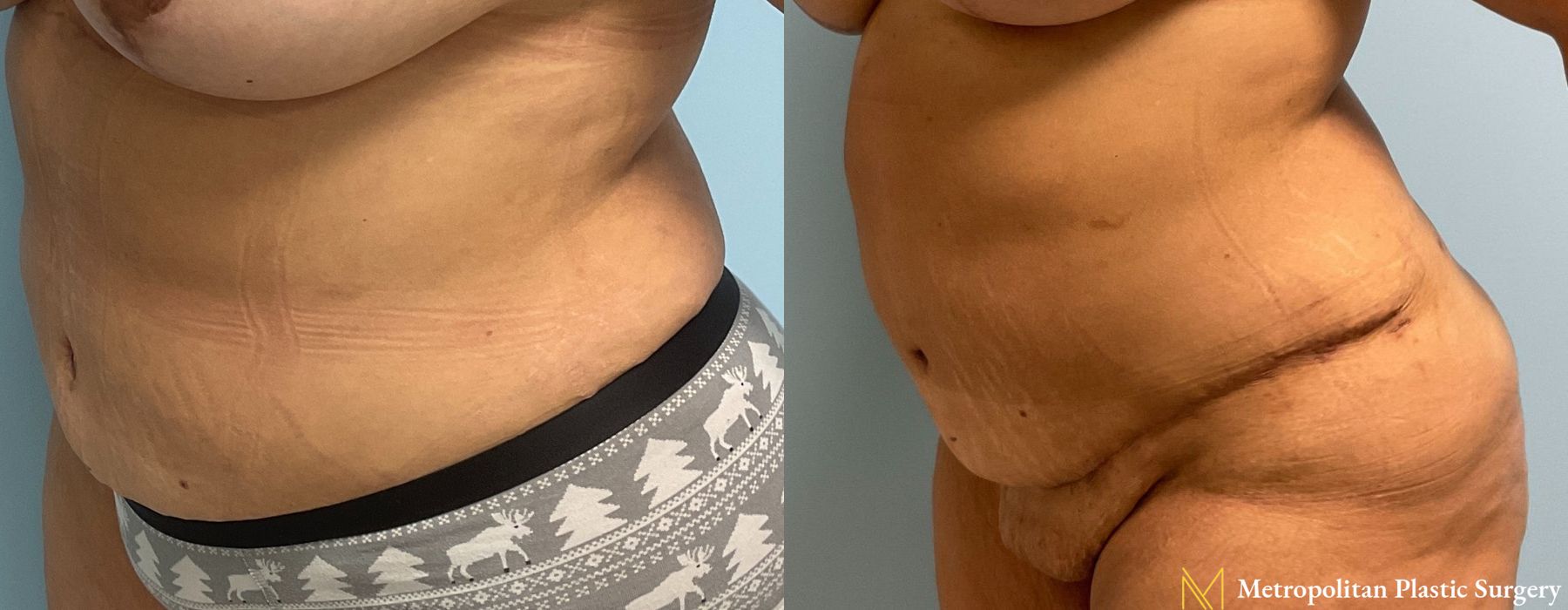 Liposuction - Thumbnail 4