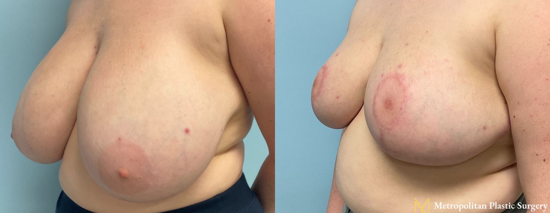 Breast Reduction - Thumbnail 2