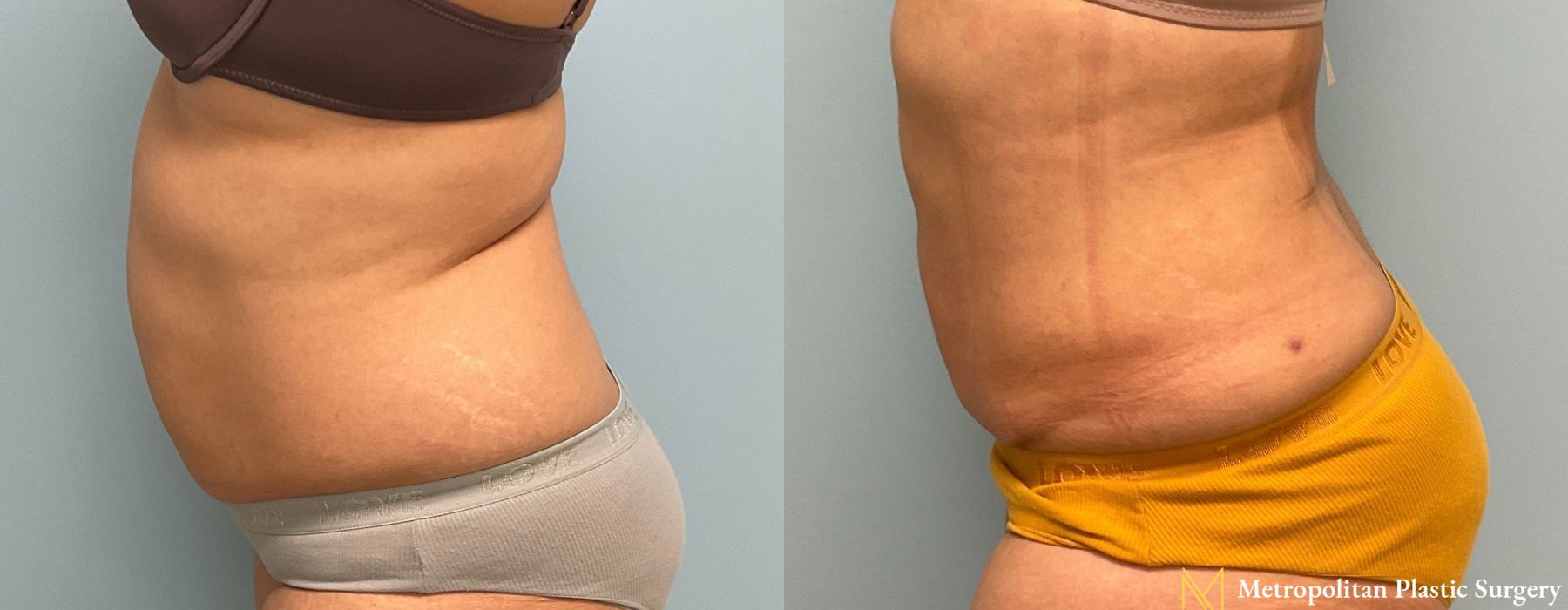 Abdominoplasty - Thumbnail 4