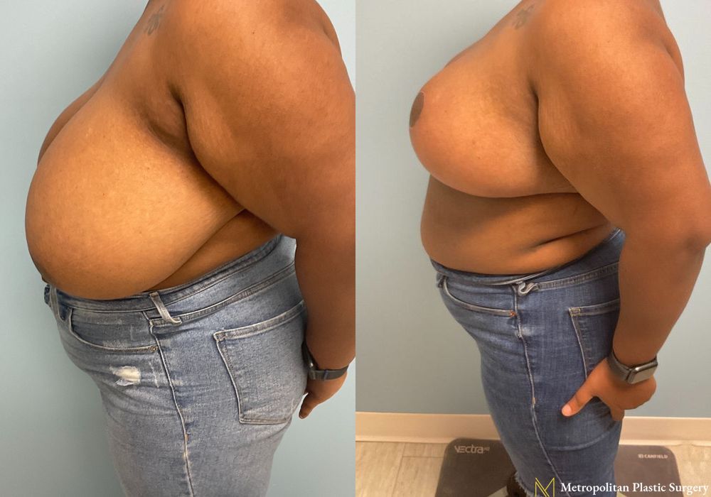 Breast Reduction - Case 106