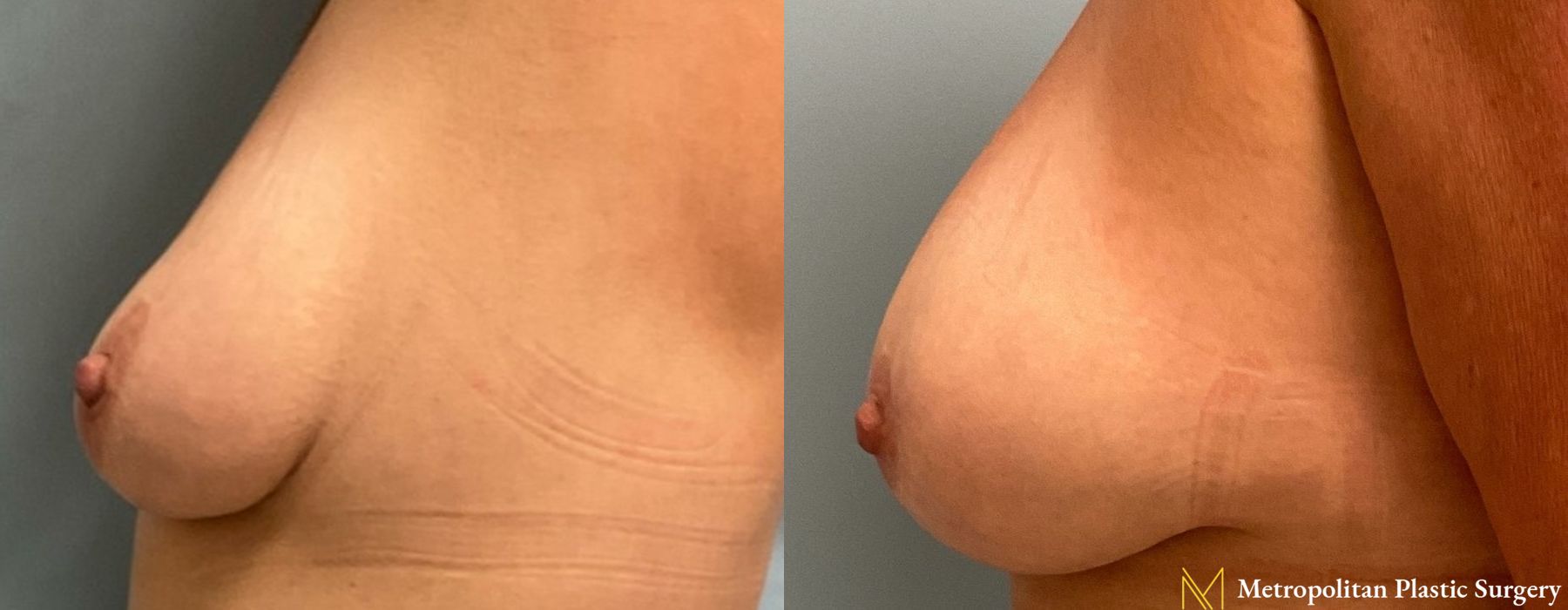 Breast Lift - Thumbnail 4