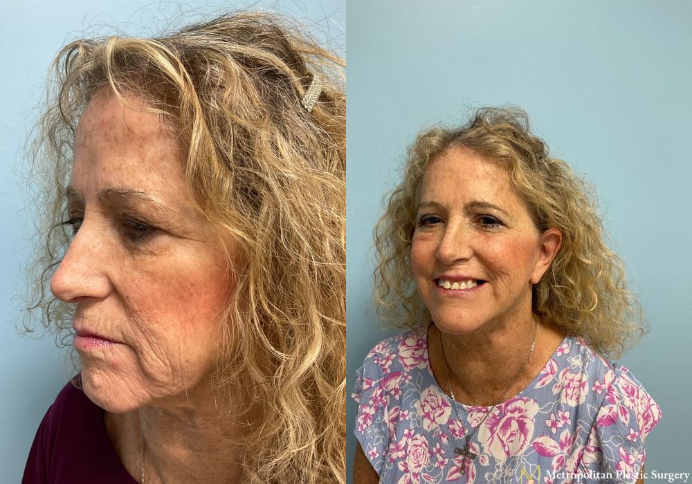 Facelift & Neck Lift - Case 128