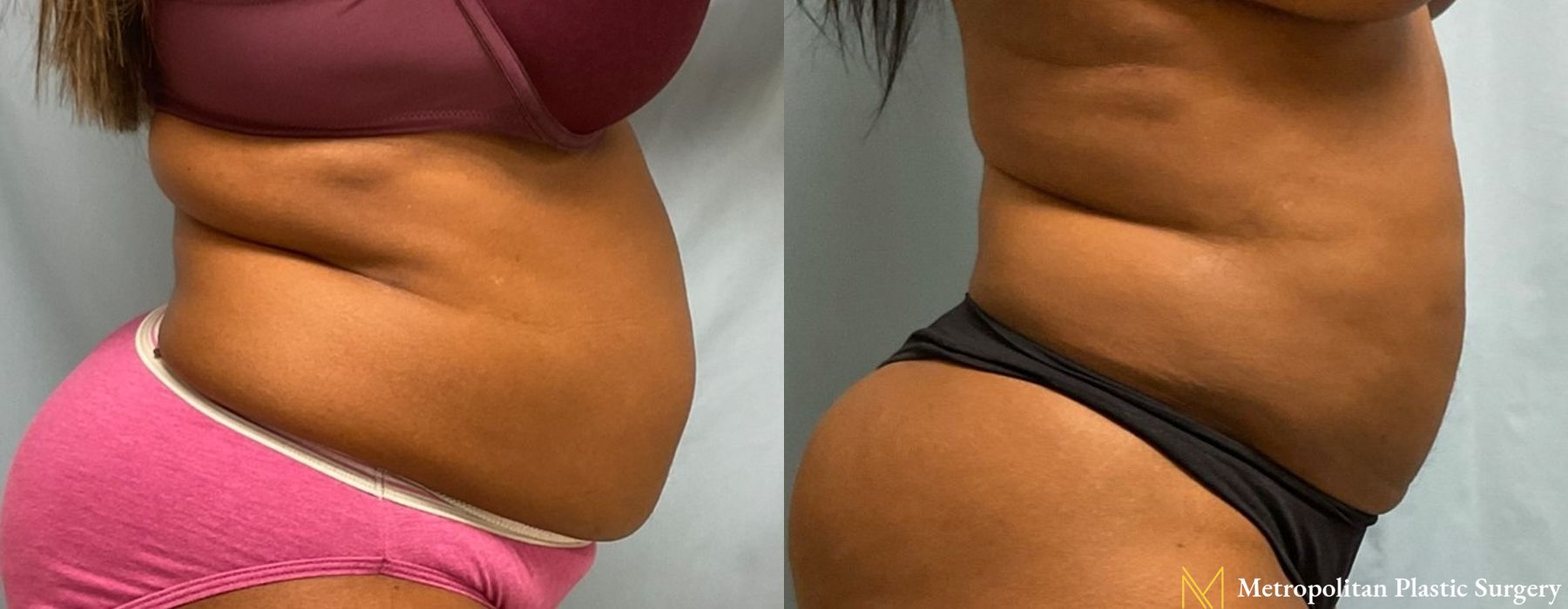 Liposuction - Thumbnail 2