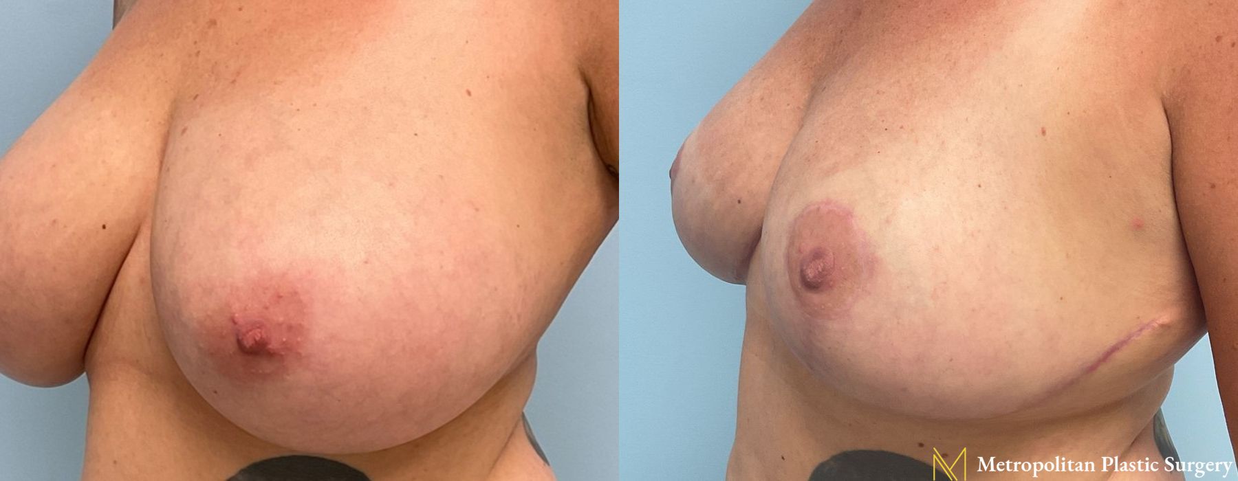Breast Reduction - Case 109