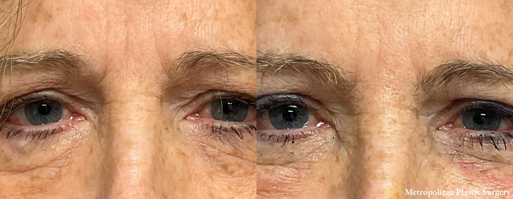 Blepharoplasty - Thumbnail 2