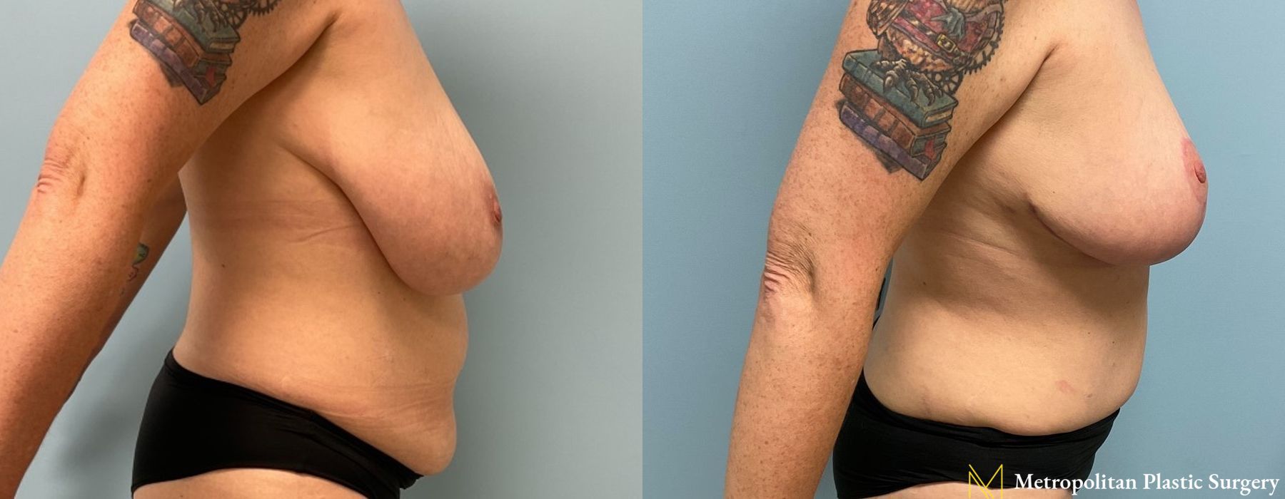 Breast Reduction - Case 112