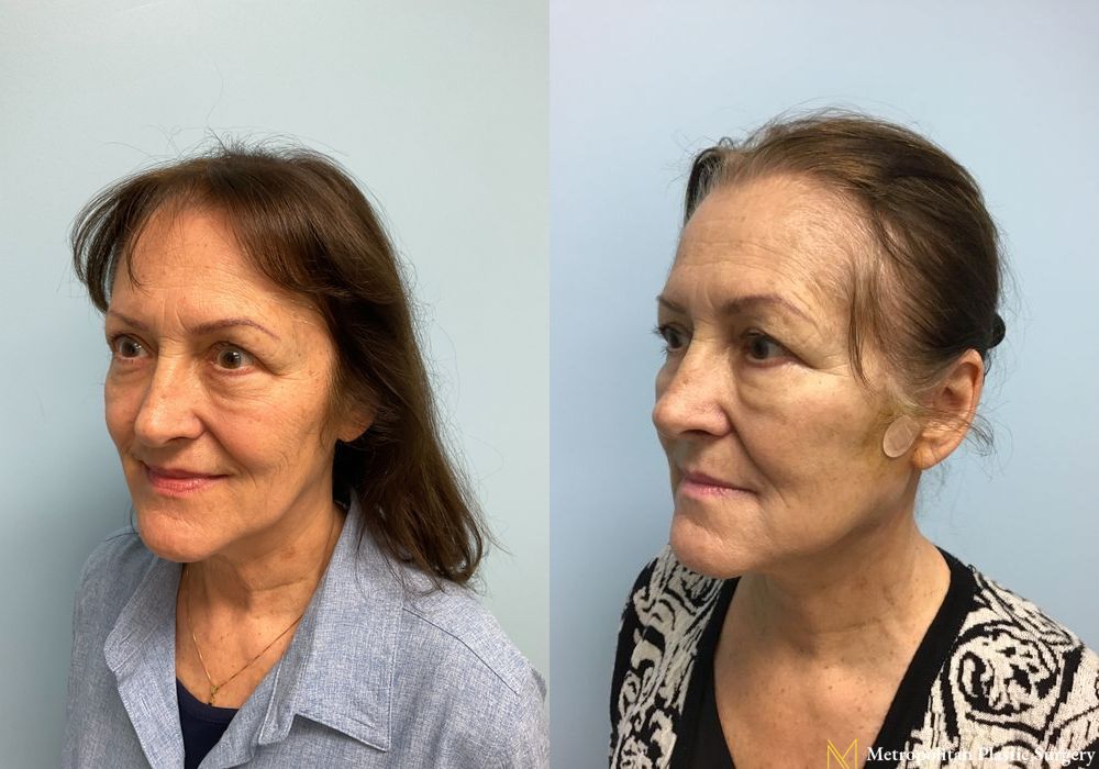 Facelift & Neck Lift - Thumbnail 2