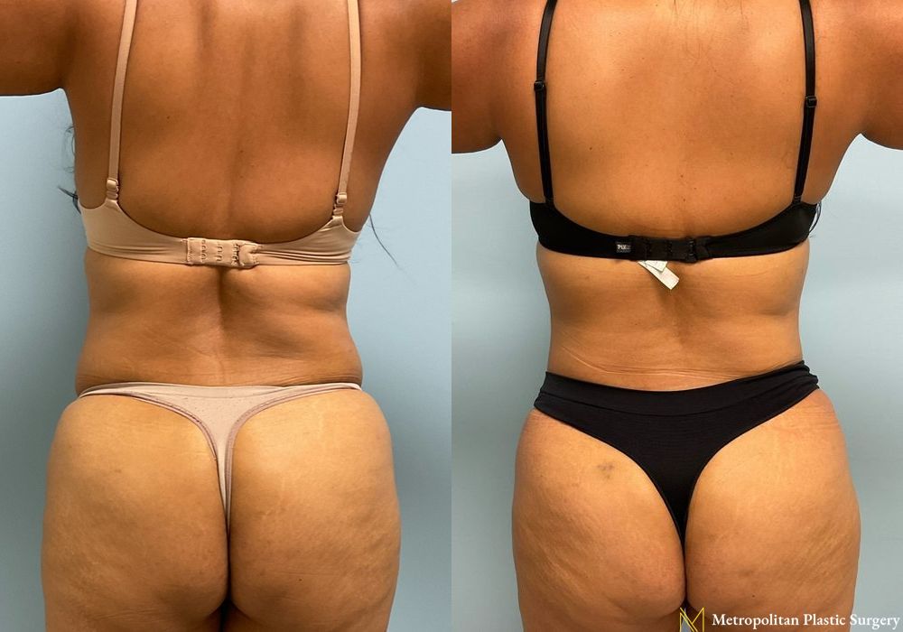 Abdominoplasty - Thumbnail 3