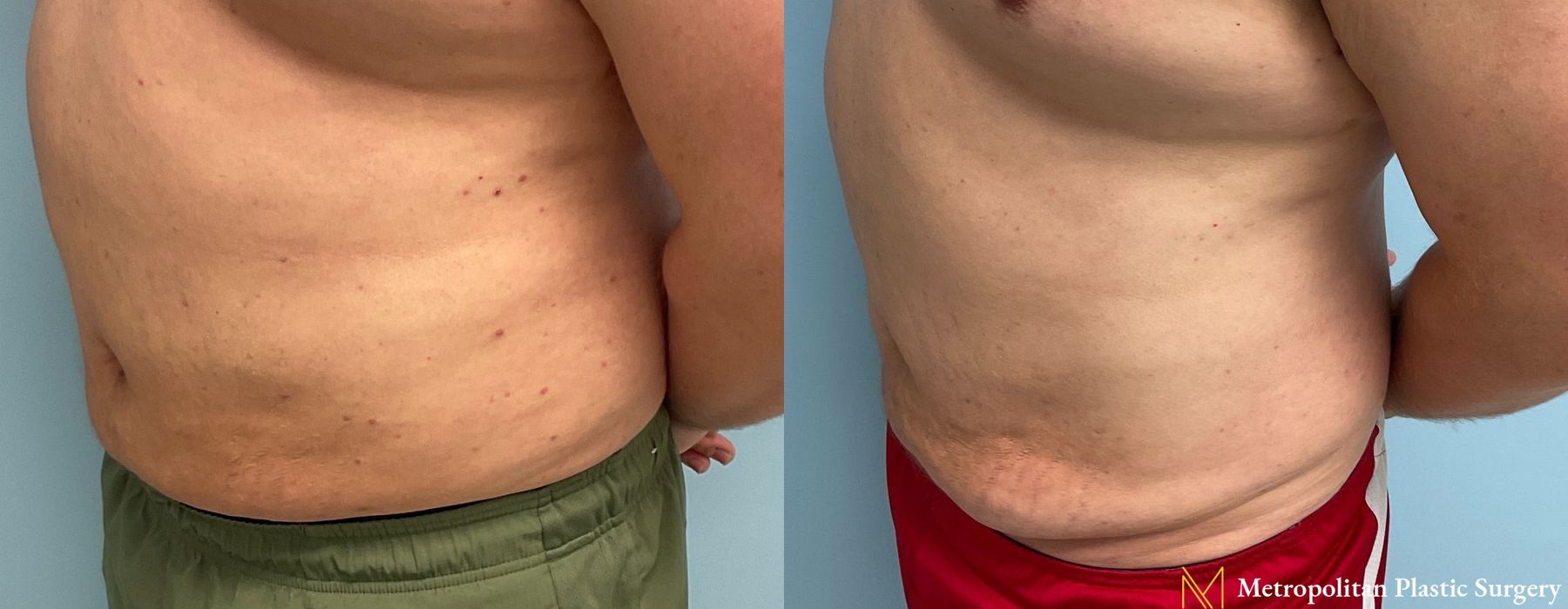 Liposuction - Thumbnail 5