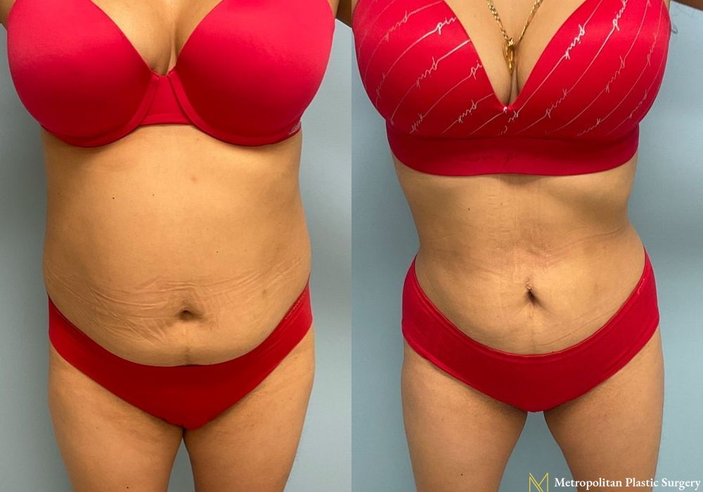 Liposuction - Thumbnail 5