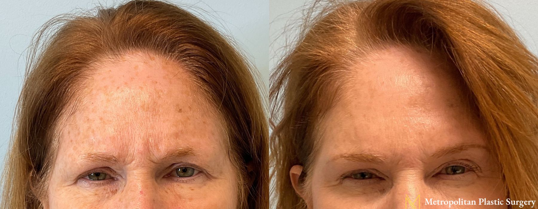 BOTOX® Cosmetic - Thumbnail 2