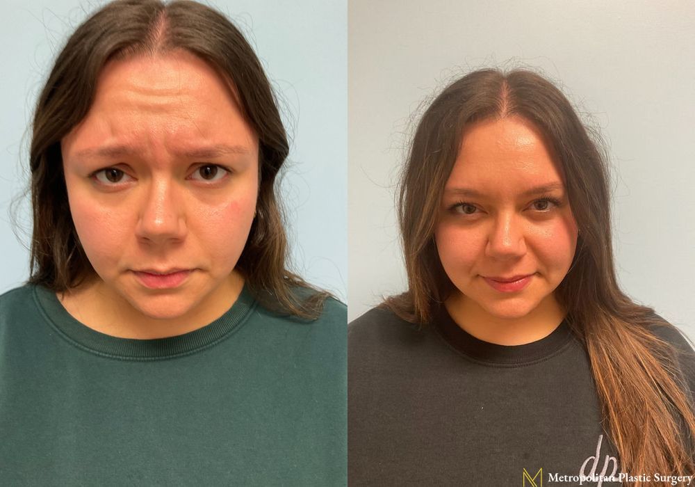 BOTOX® Cosmetic - Thumbnail 2