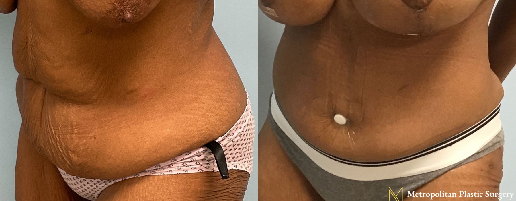 Liposuction - Thumbnail 3