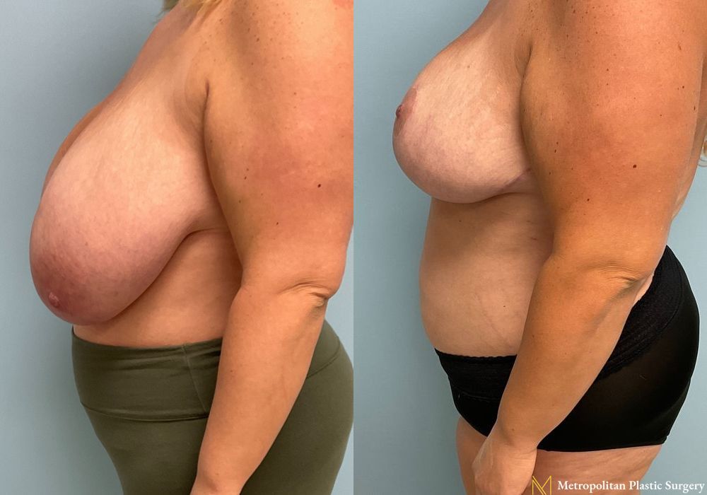 Breast Reduction - Thumbnail 5