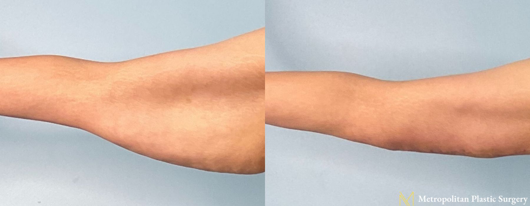 Brachioplasty - Thumbnail 2