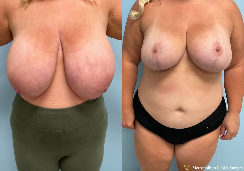 Breast Reduction - Thumbnail 3