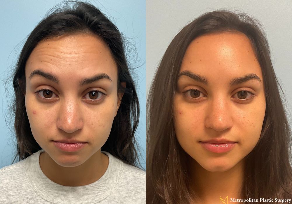 BOTOX® Cosmetic - Case 141