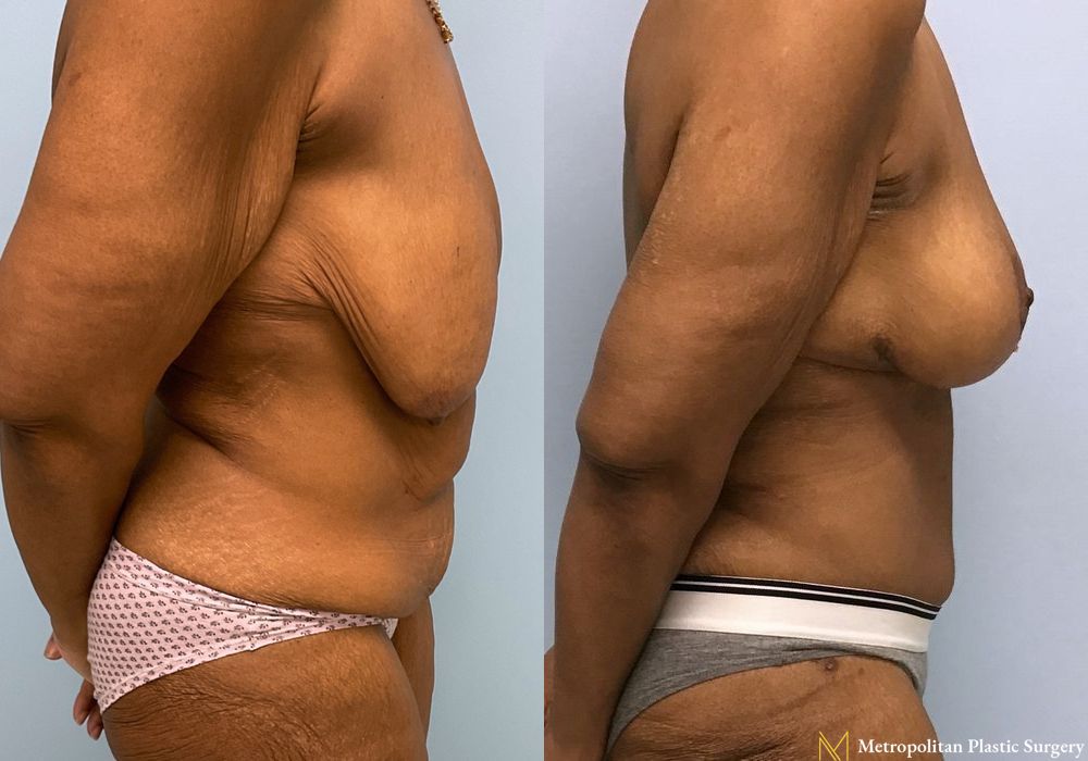 Abdominoplasty - Thumbnail 5