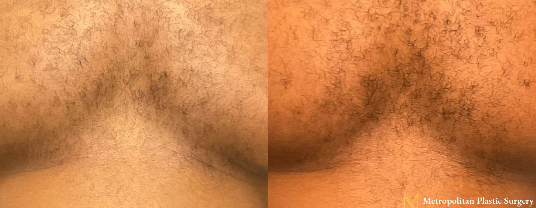 Gynecomastia - Case 114