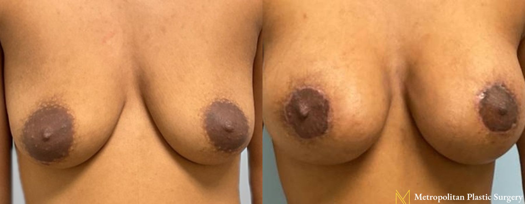 Breast Lift with Implants - Thumbnail 3