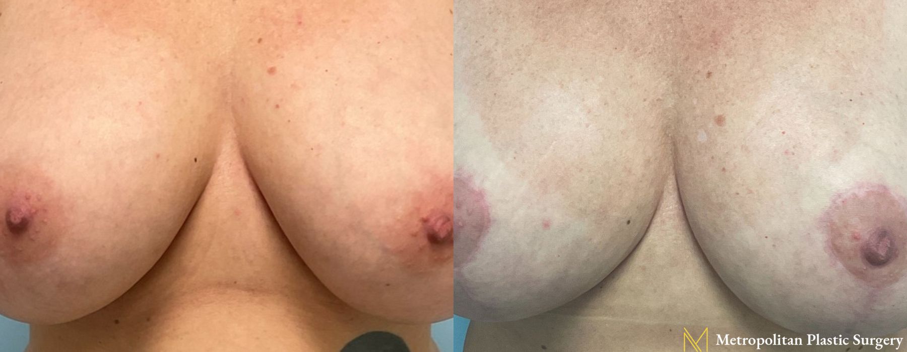 Breast Reduction - Thumbnail 3