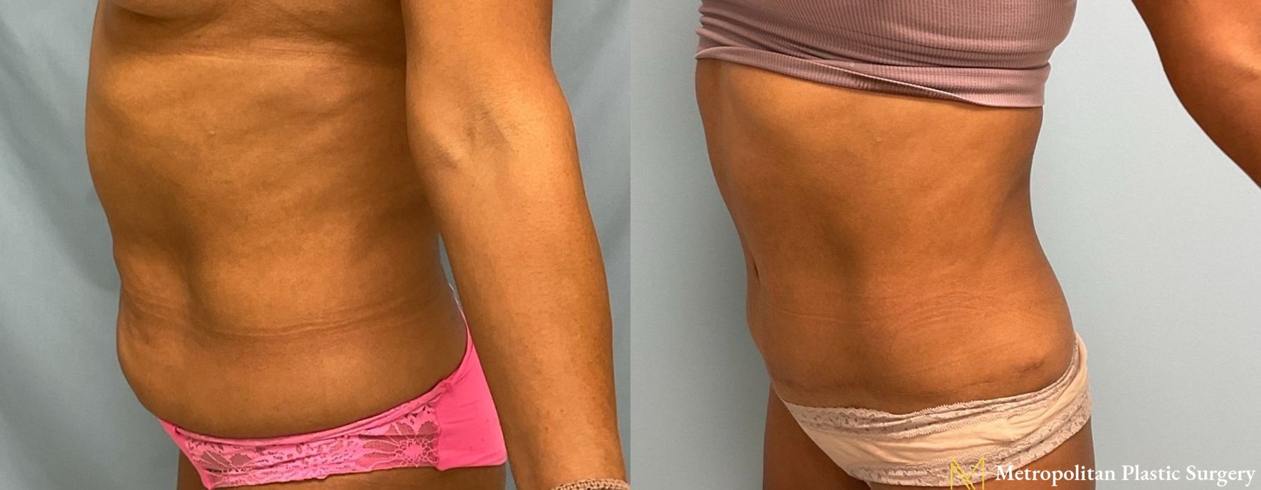 Abdominoplasty - Thumbnail 3