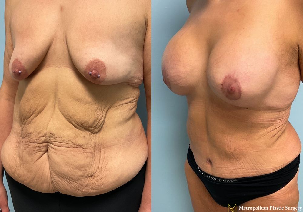 Abdominoplasty - Thumbnail 5