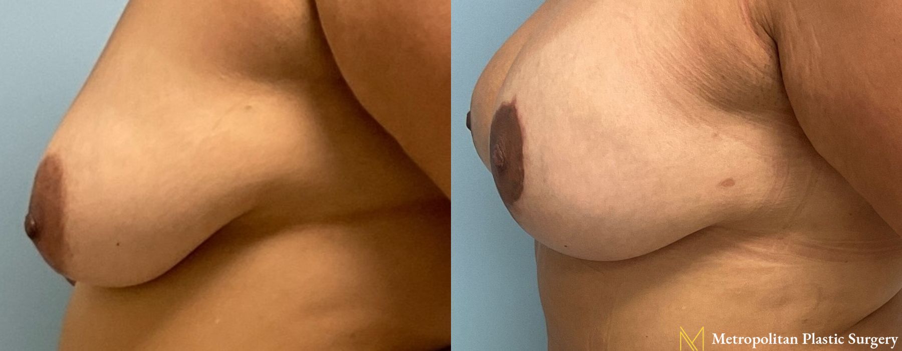 Breast Augmentation - Thumbnail 4