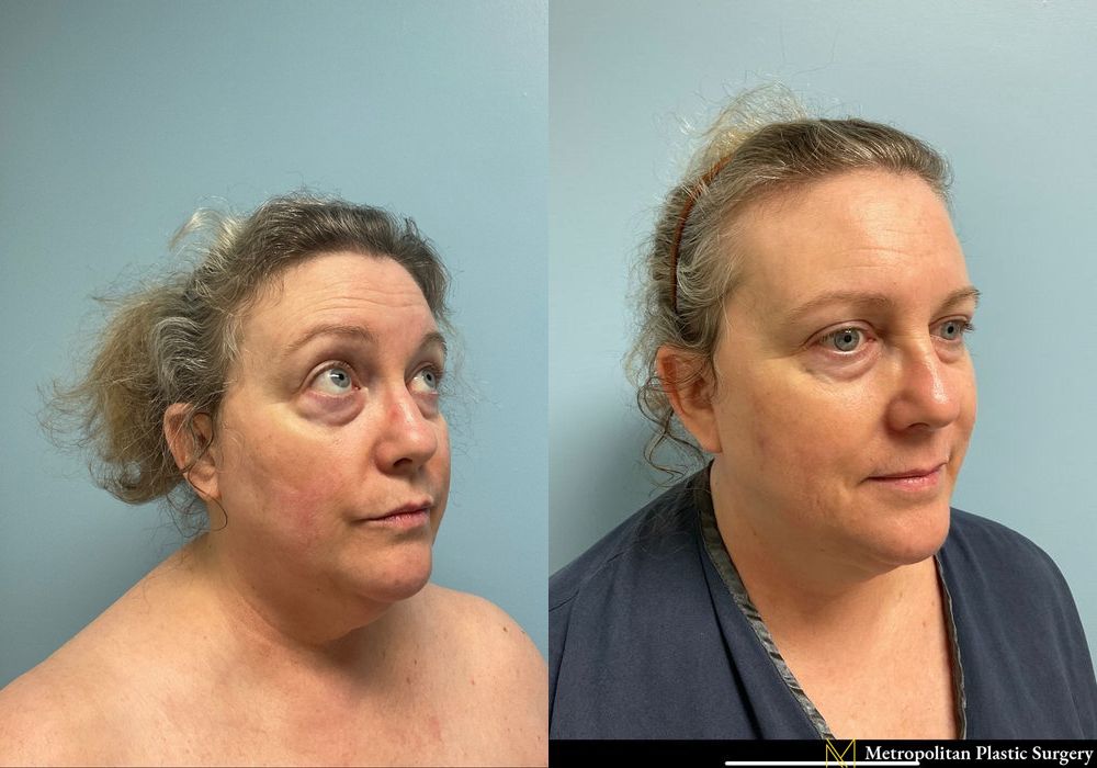 Facelift & Neck Lift - Thumbnail 3