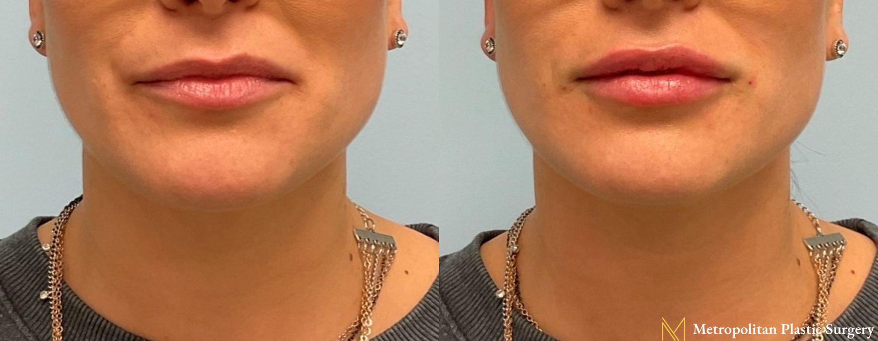 Fillers - Thumbnail 4