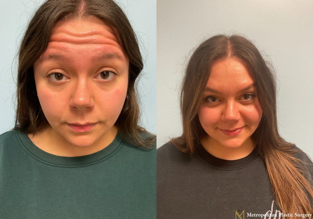 BOTOX® Cosmetic - Case 142