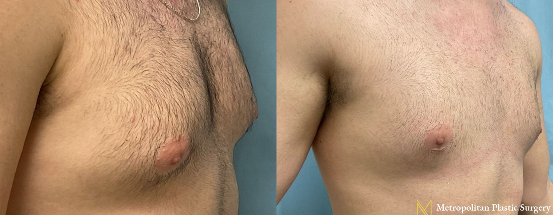 Gynecomastia - Thumbnail 2