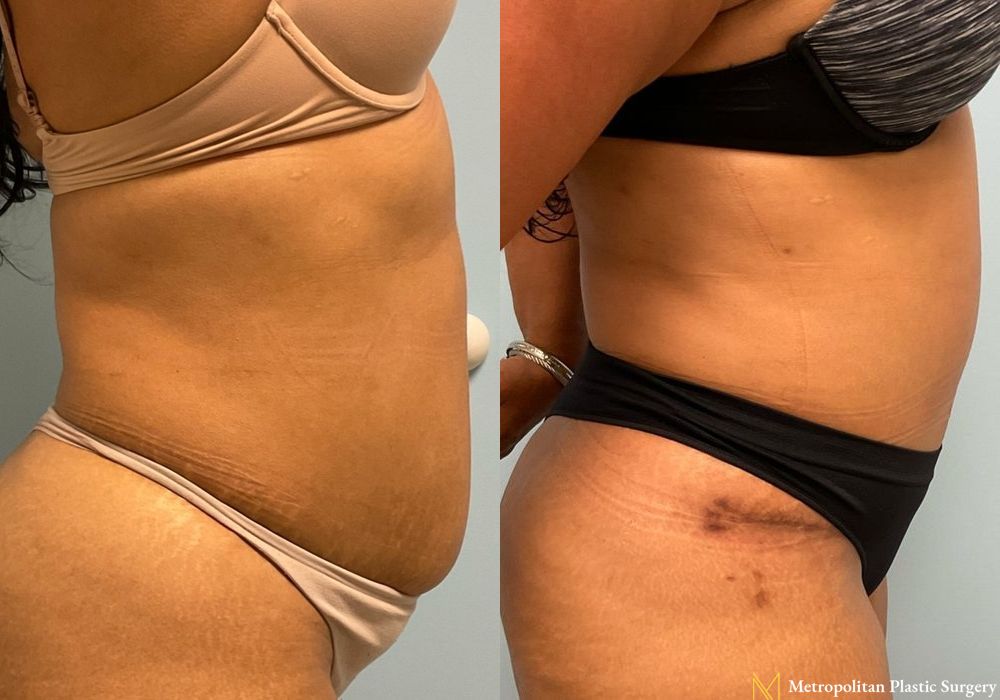 Abdominoplasty - Case 64