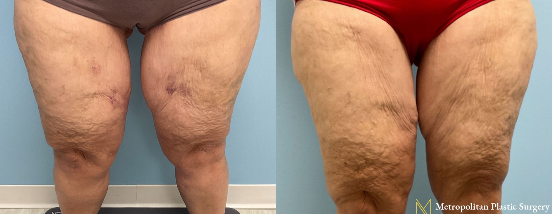 Liposuction - Case 206